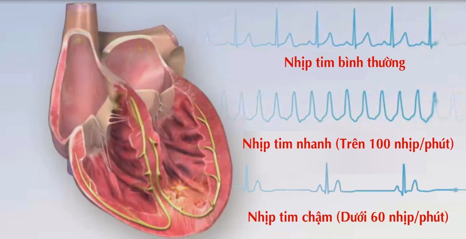 Cảnh giác các dấu hiệu của bệnh tim mạch nghiêm trọng