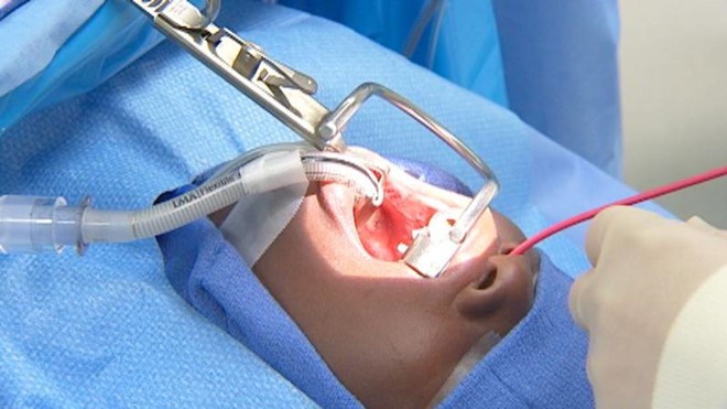 Phẫu thuật cắt amiđan