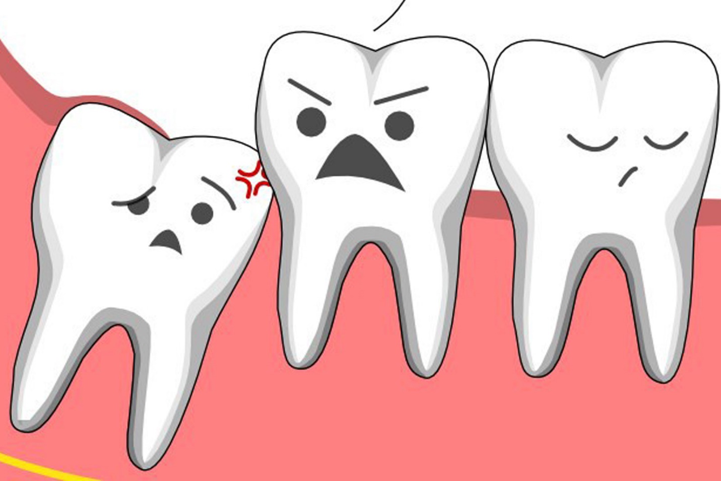 Trường hợp nào nên nhổ răng khôn, khi nào nên giữ lại? - Bệnh học 4 phương