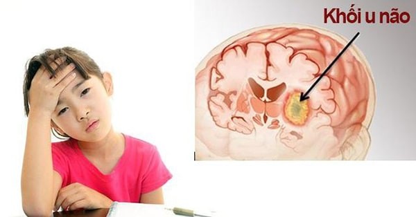 bệnh u não ở trẻ em 
