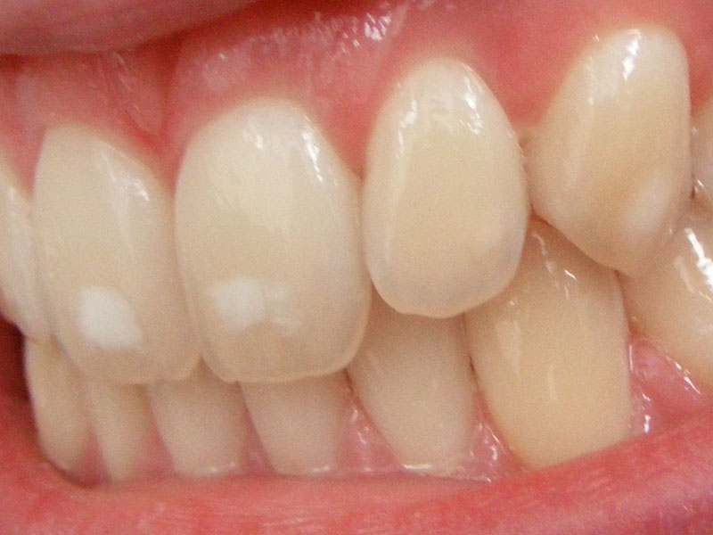 giai đoạn của sâu răng