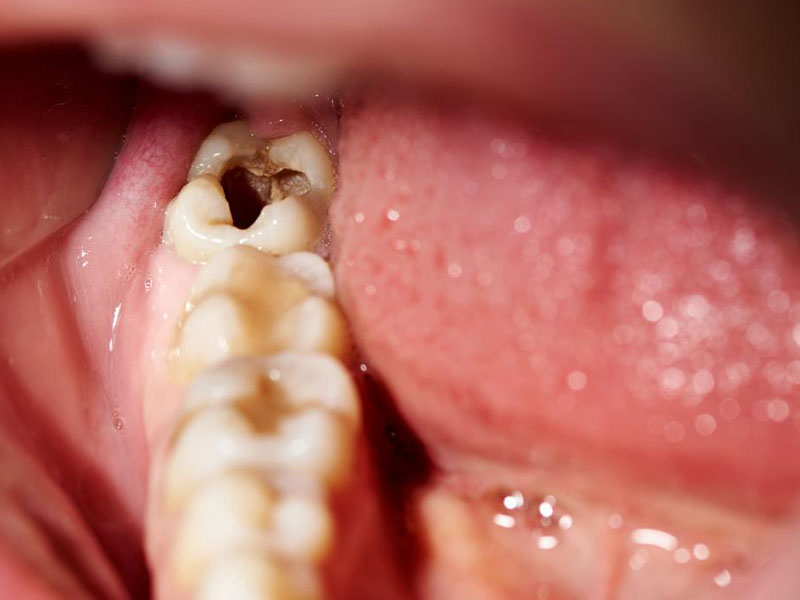 giai đoạn của sâu răng