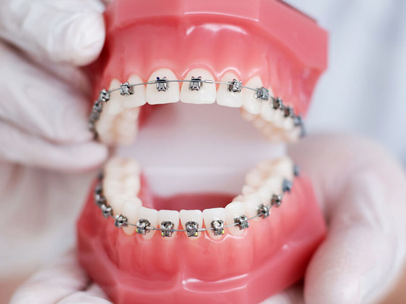 Những điều cần biết nếu muốn niềng răng đẹp, nhanh và hiệu quả nhất