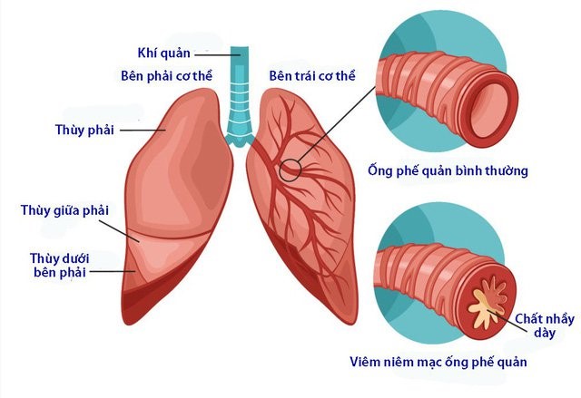 viêm phế quản tiến triển thành viêm phổi