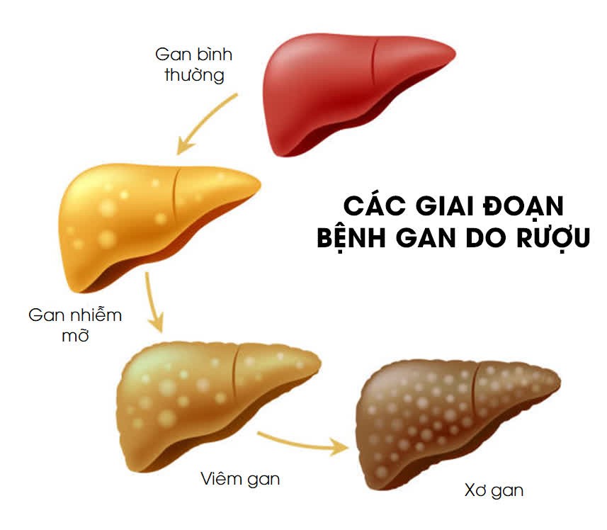 uống nhiều rượu bia 