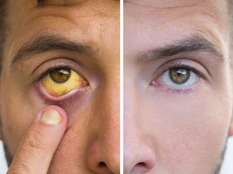 Vàng mắt và vàng da là dấu hiệu bị suy gan cấp