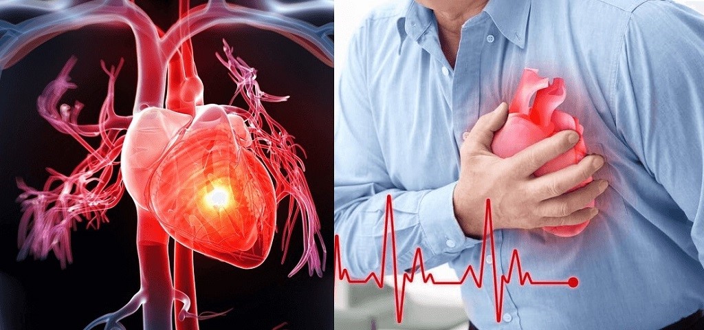Căng thẳng làm tăng nguy cơ bị đau tim, đột quỵ