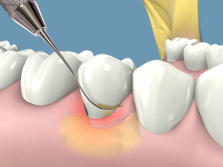 Lấy cao răng định kỳ giúp phòng ngừa viêm nướu, sâu răng