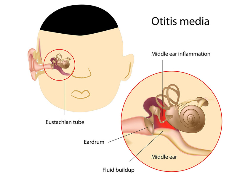 Ống Eustachian trong tai của trẻ nhỏ hơn nên dễ lây nhiễm vi khuẩn khi viêm họng
