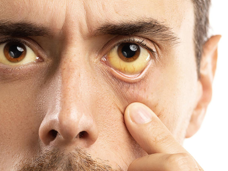 Nếu ngứa da và vàng mắt xuất hiện đồng thời thì nên đi khám bác sĩ