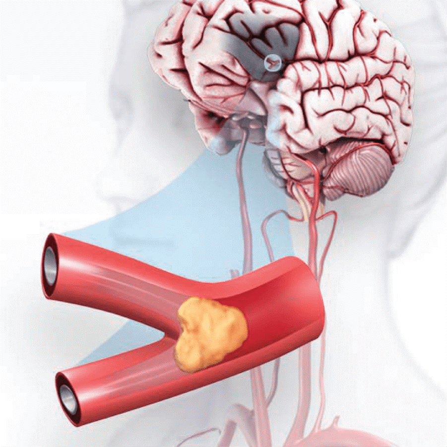 Đột quỵ xảy ra do cục máu đông ngăn chặn dòng máu lên não