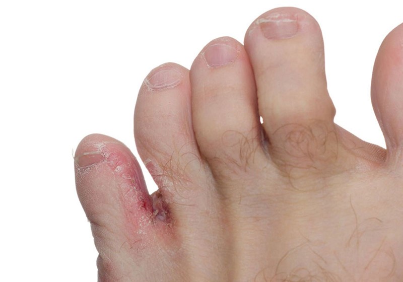 Bệnh nấm da chân là một loại nhiễm trùng ở ngón chân hoặc bàn chân