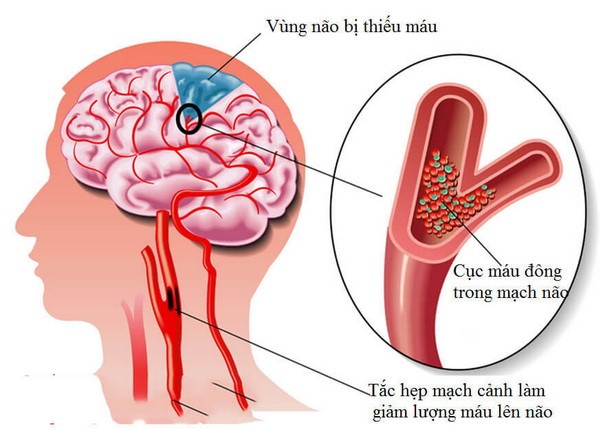 Thiếu máu não là nguyên nhân phổ biến gây đau đầu, chóng mặt
