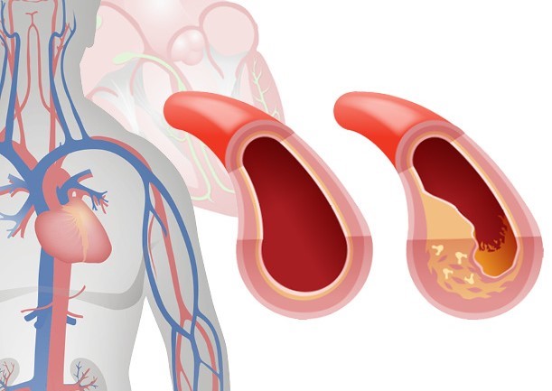 Xơ cứng động mạch là nguyên nhân dẫn đến đau tim, đột quỵ