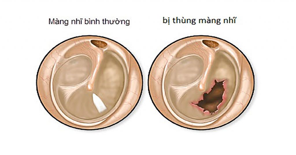 Viêm tai giữa gây biến chứng thủng màng nhĩ